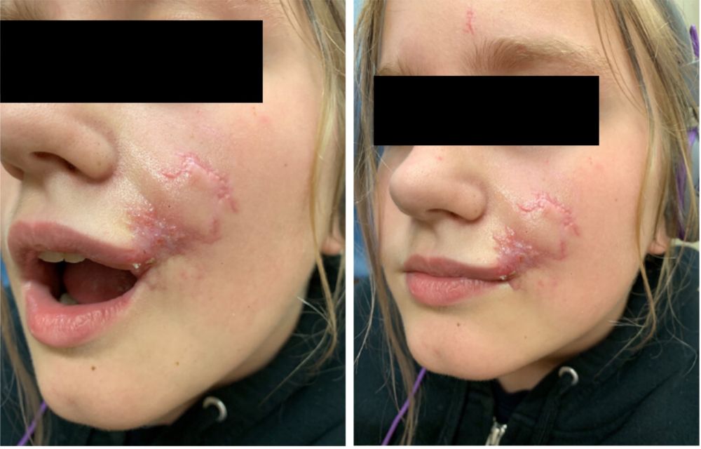 Repair Of Facial Dog Bite Wound Utilizing Cryopreserved Umbilical Cord repair-of-facial-dog-bite-wound-utilizing-cryopreserved-umbilical-cord